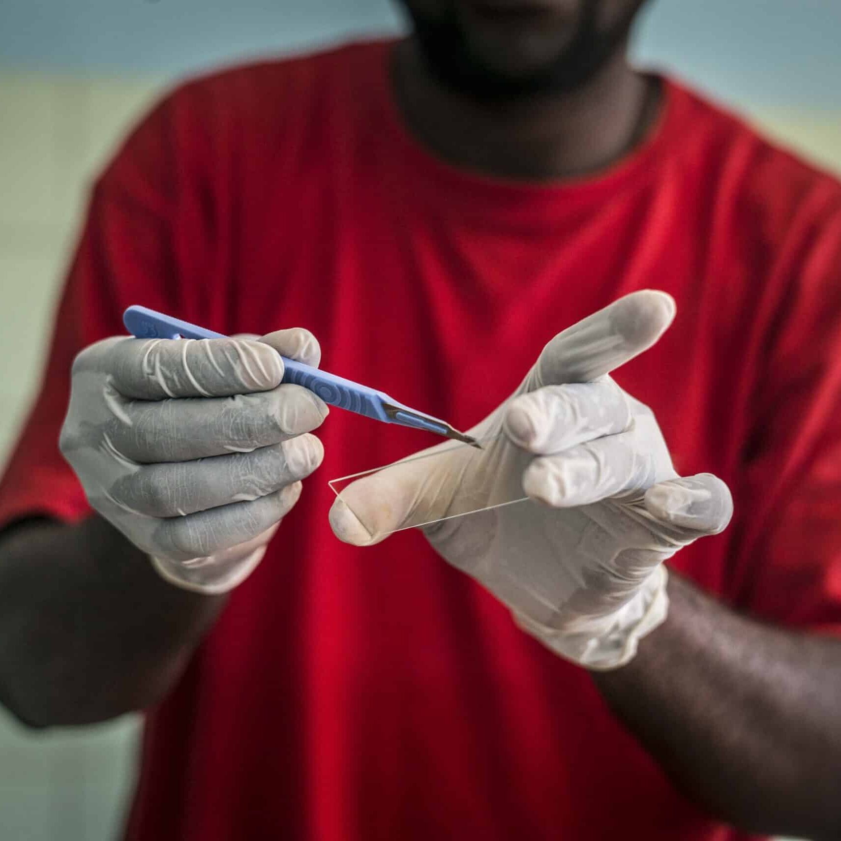 20180425 - ACTION DAMIEN COMORES , Anjouan.  Prelevement sur patients de la lepre pour études. Hadidja Allaoui, 18 ans , lepre MB , depistée le 25/04/18
PHOTO: JOHANNA DE TESSIERES / COLLECTIF HUMA